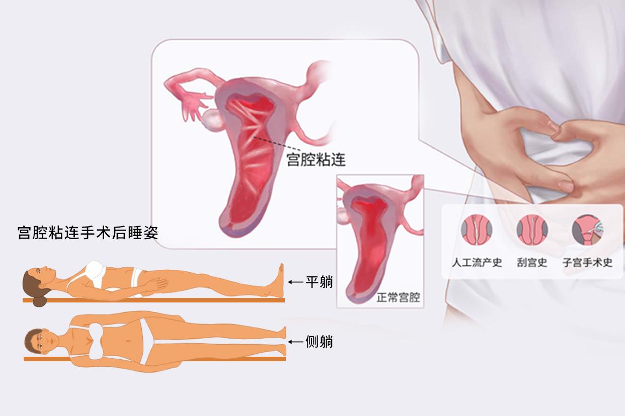 宫腔粘连手术后睡姿正确图片 宫腔粘连手术后睡姿正确图片大全