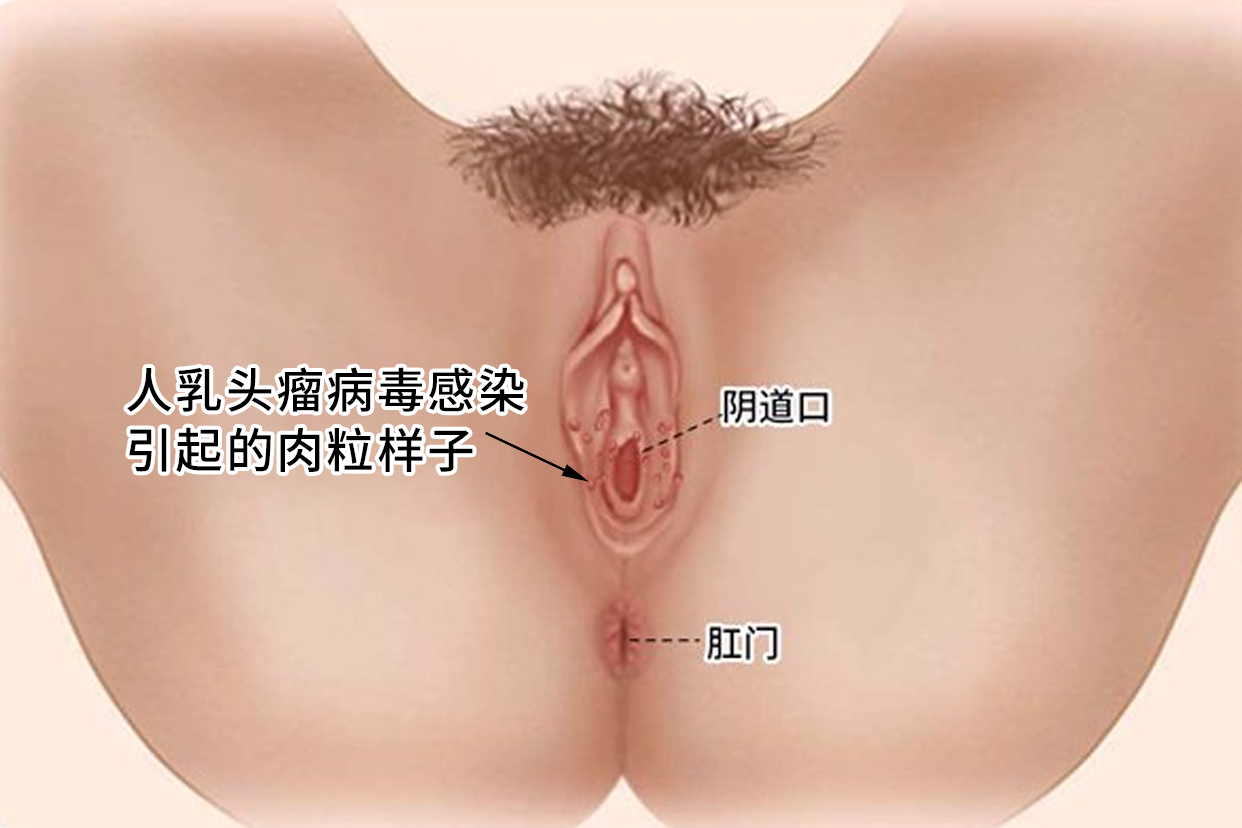 hpv的肉粒是什么样的（hpv的肉粒是什么样的图片）