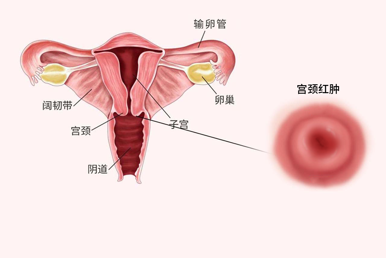 宫颈红肿图片 宫颈红肿图片大全