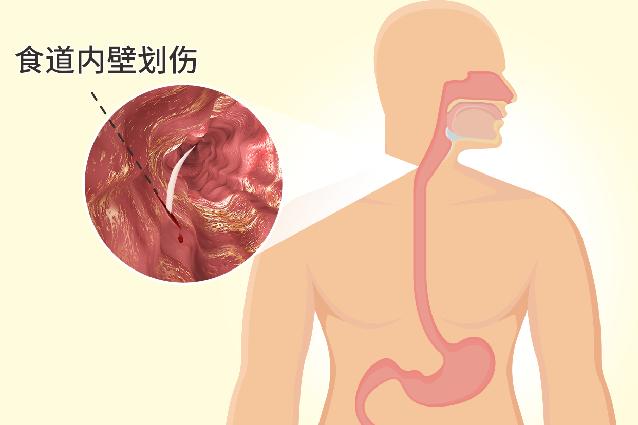 食道划伤图片（怎么判断食道划伤）