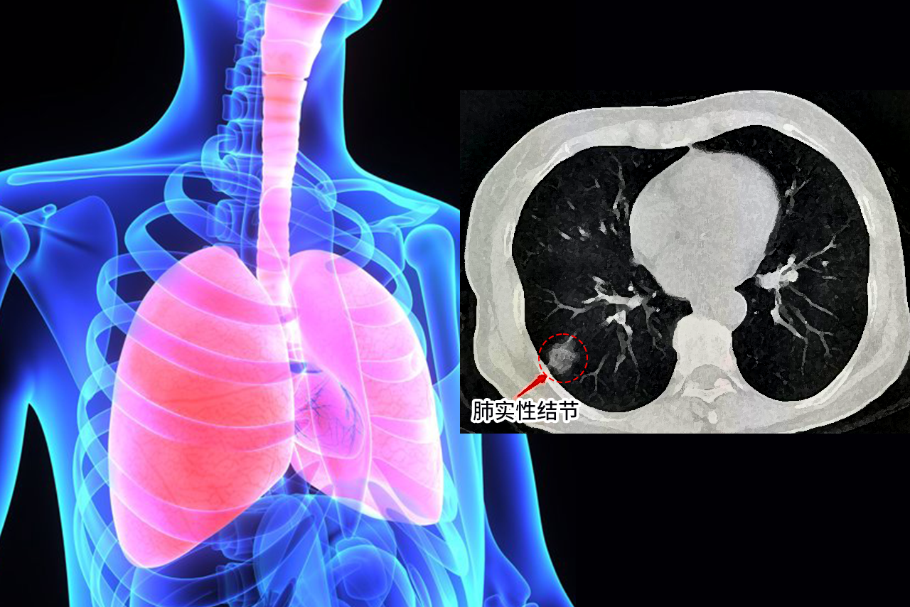 肺实性结节图片 肺实性结节图片高清