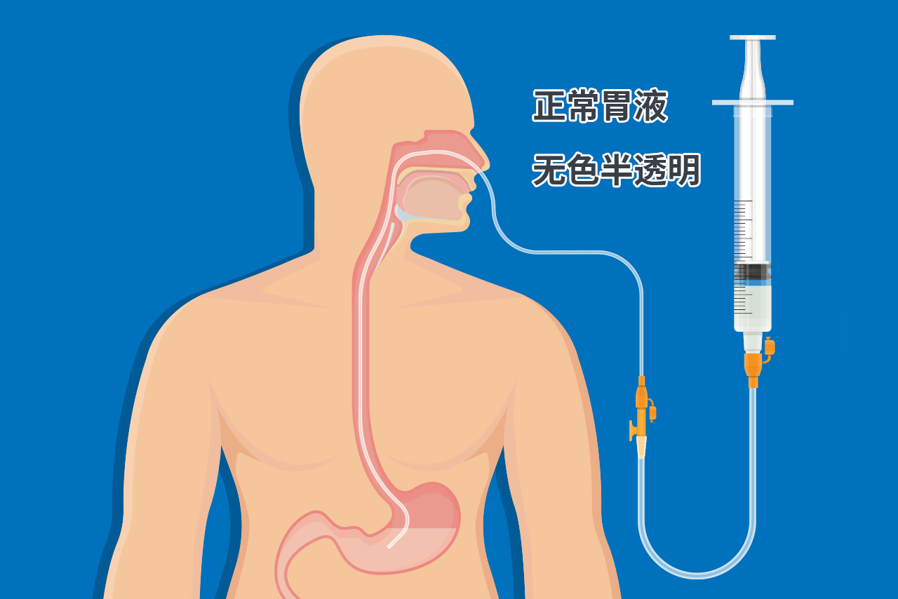 正常胃液颜色的图片 正常胃液是什么颜色