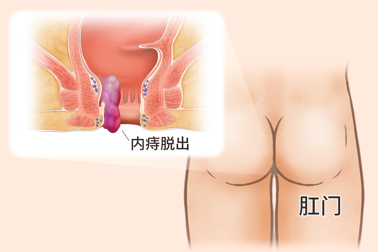 内痔痔核脱出的照片 怎么让痔核萎缩消失