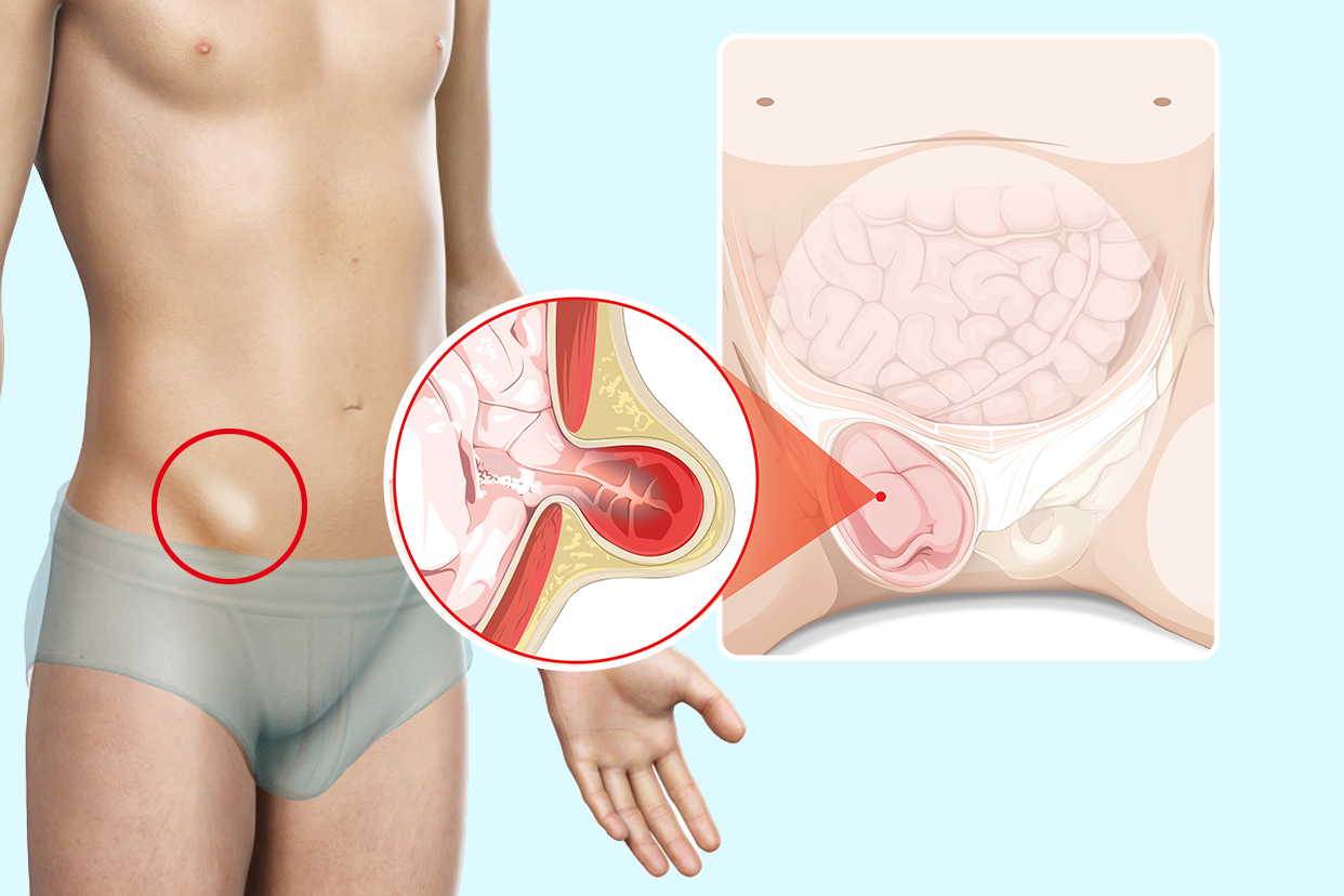 小儿腹沟疝刚发生图片 小儿腹沟疝一定要手术吗