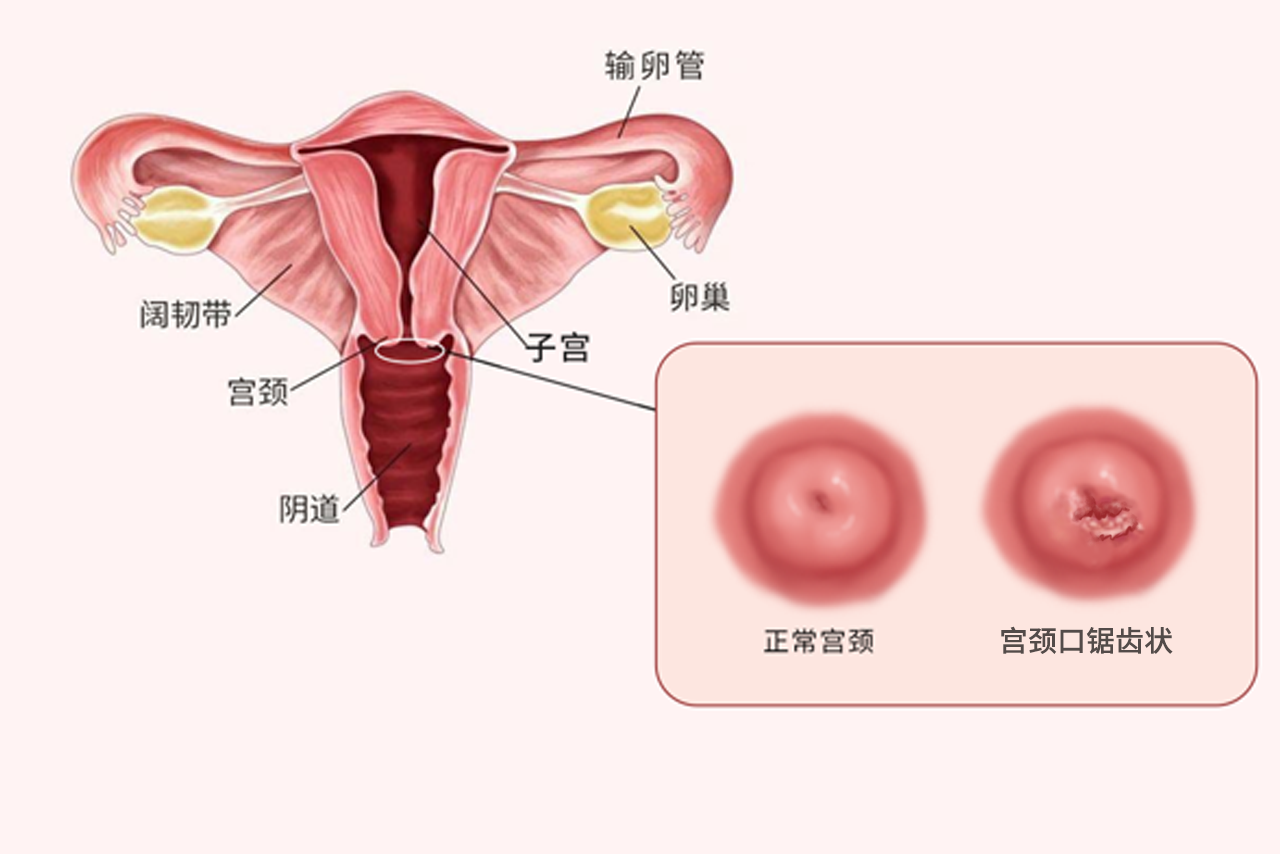 宫颈口锯齿状图片 宫颈口锯齿状是什么病