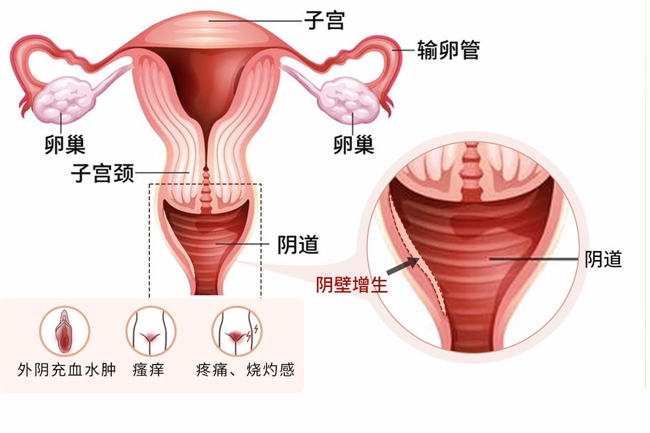 阴壁增生症状图片（阴壁增生症状图片大全）