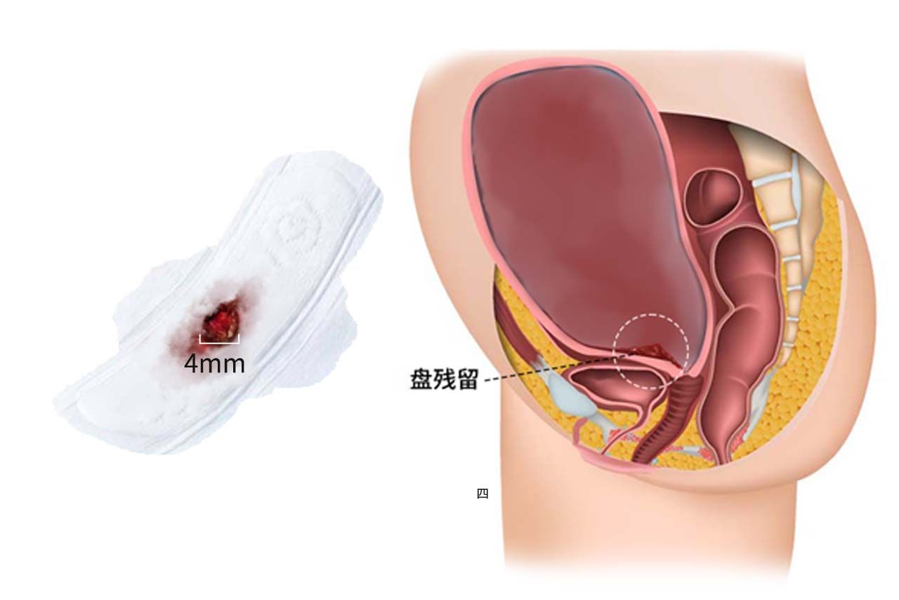 排出的残留物4mm的图片（排出的残留10mm的图片）