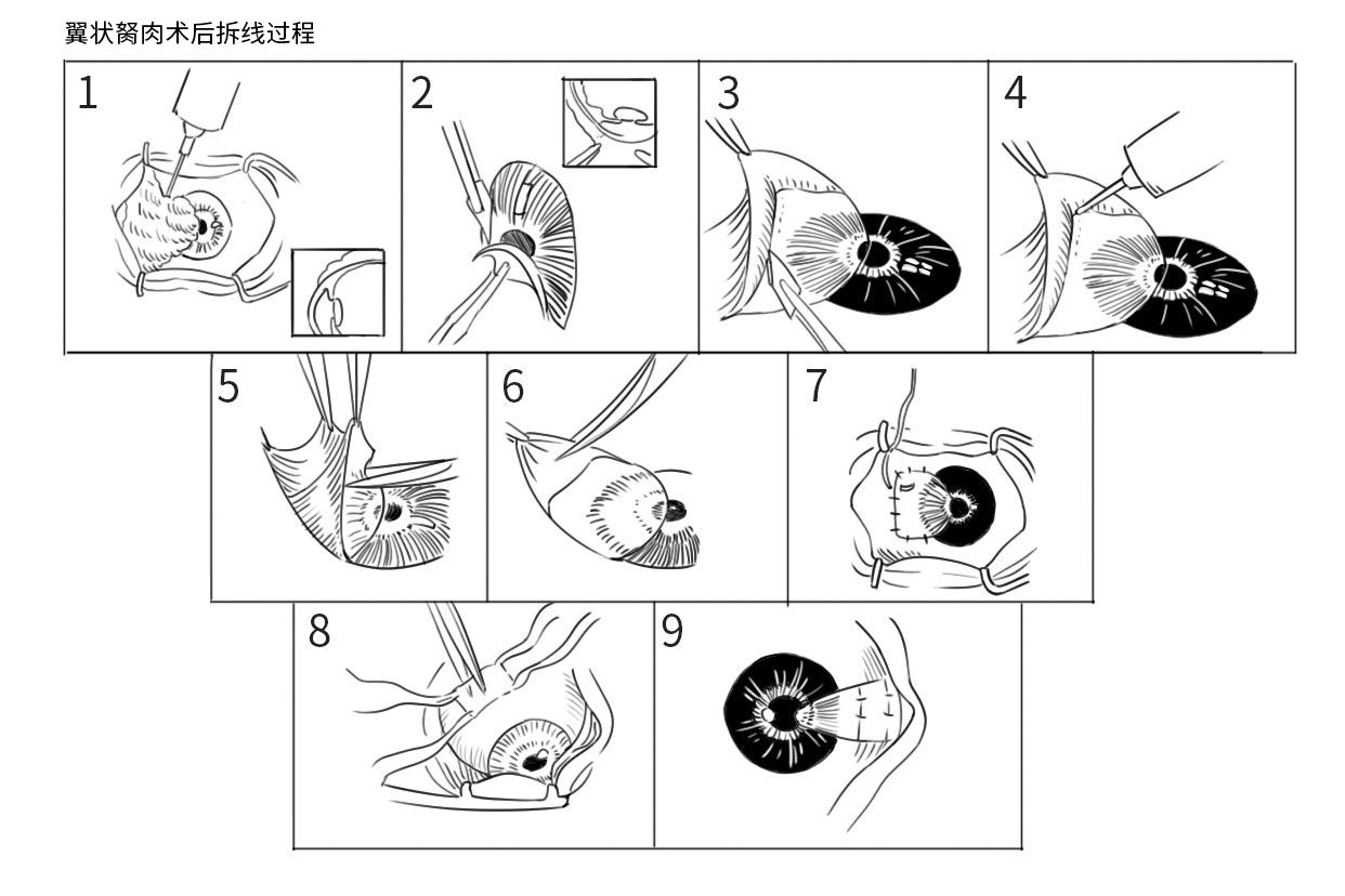 翼状胬肉术后拆线过程图（翼状胬肉手术后拆线图）