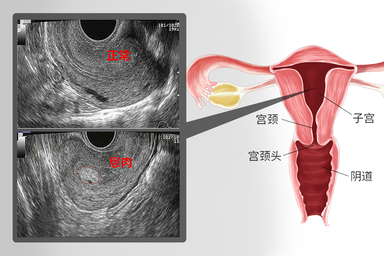 子宫息肉的b超图像 子宫息肉b超图片