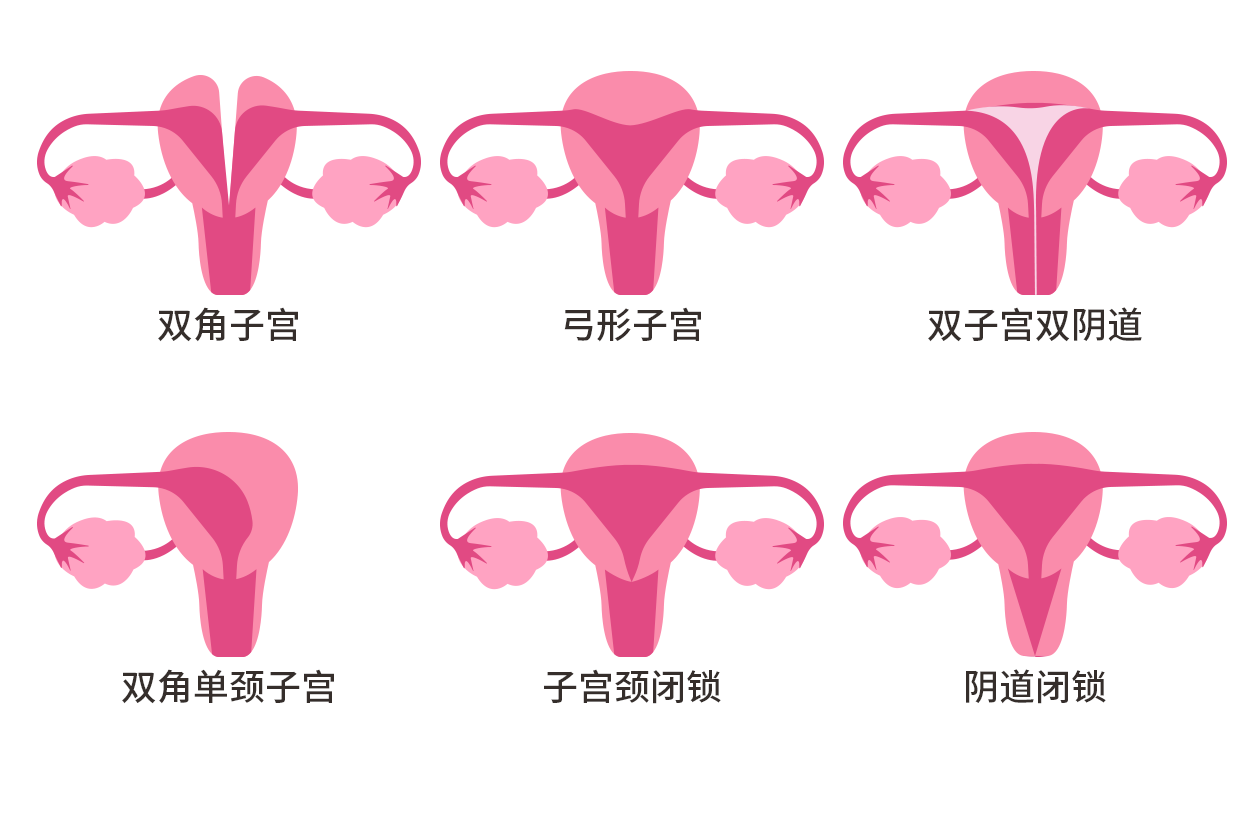 残角子宫示意图（残角子宫图片 图解）