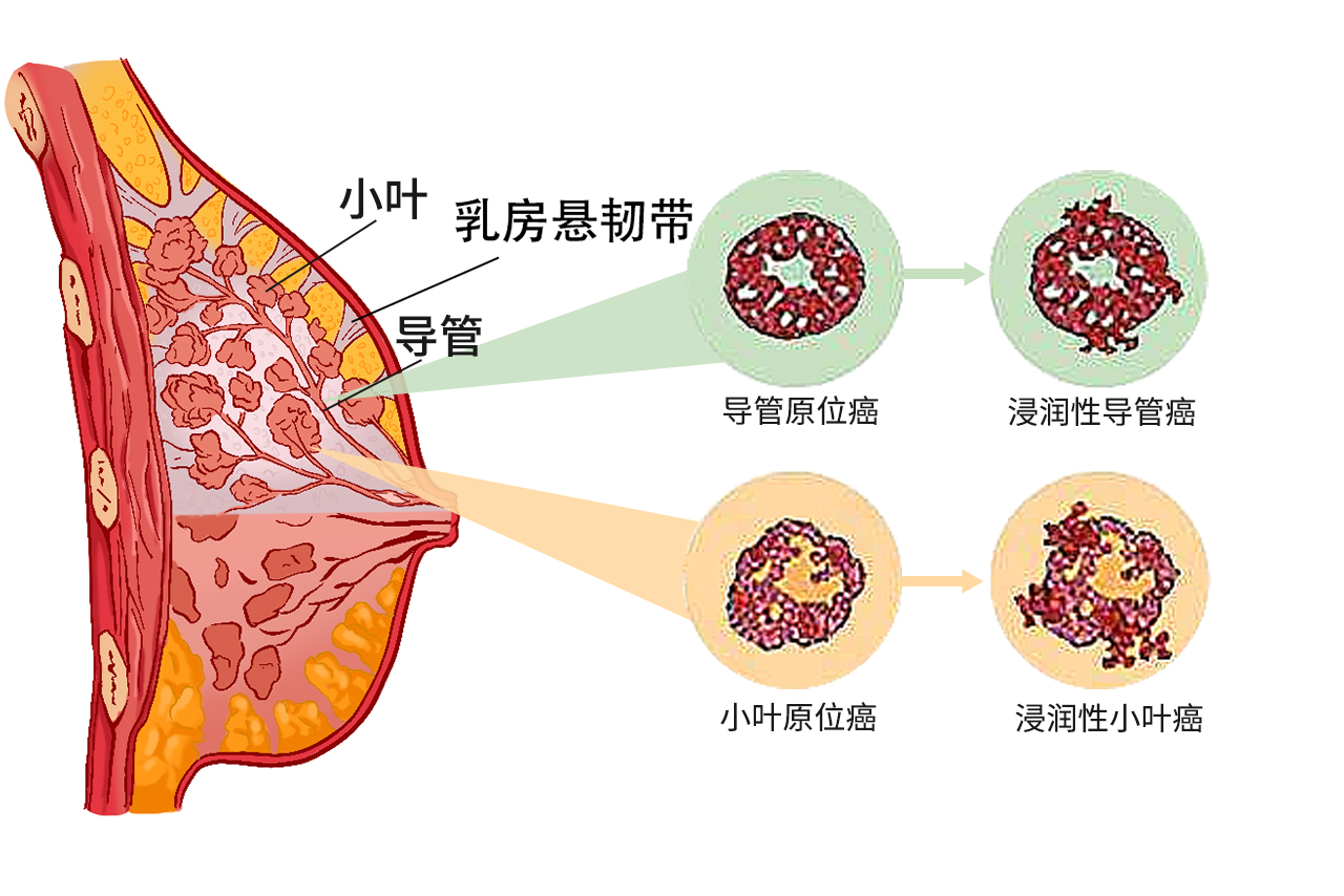 浸润性乳腺癌的图片和症状有哪些 浸润性乳腺癌临床表现