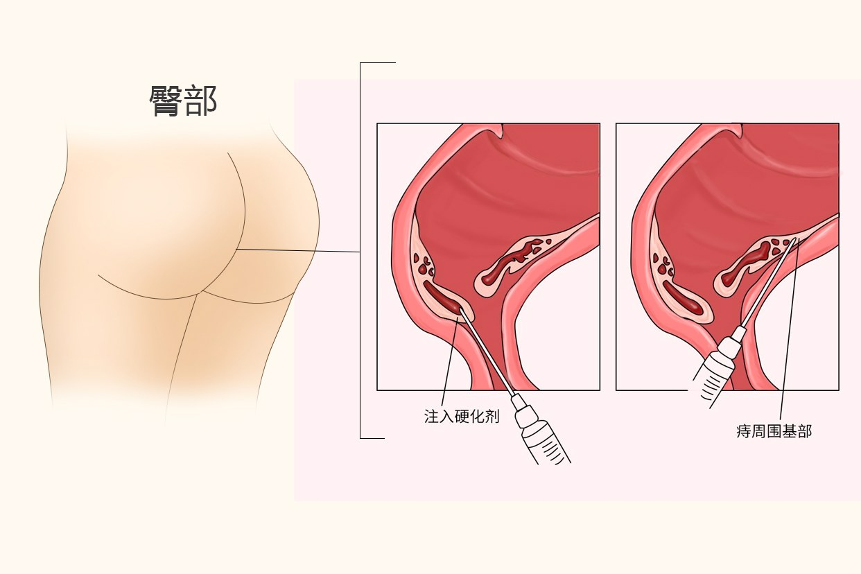 痔疮打针后一个星期后图片 痔疮打针后一个星期了还流血