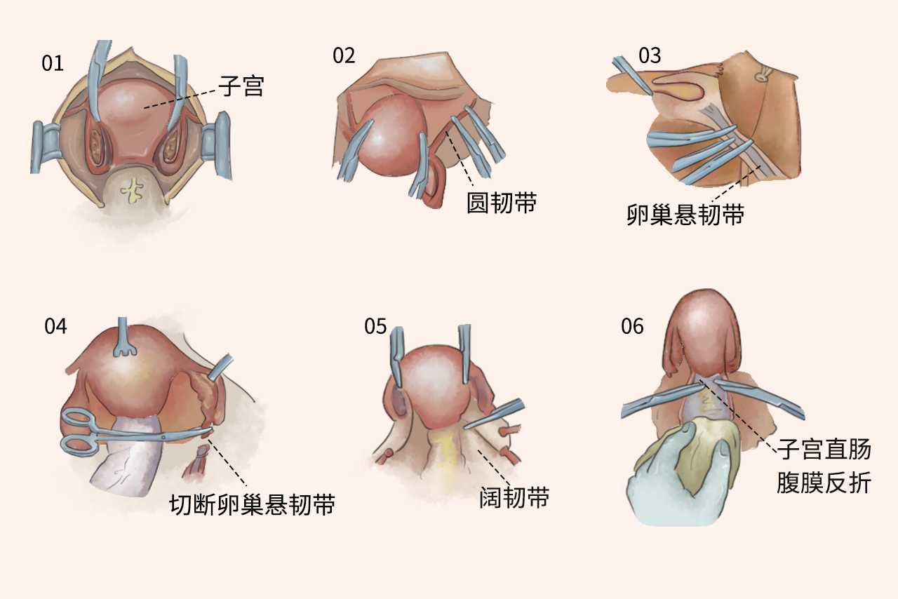 子宫卵巢的切除手术示意图 子宫卵巢的切除手术示意图视频