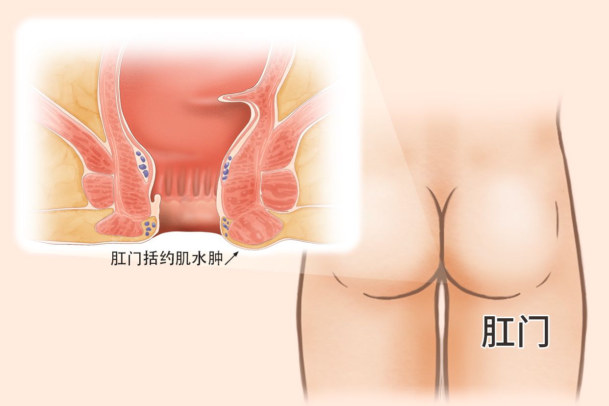 肛门括约肌水肿图片 肛门括约肌肿大怎样消肿