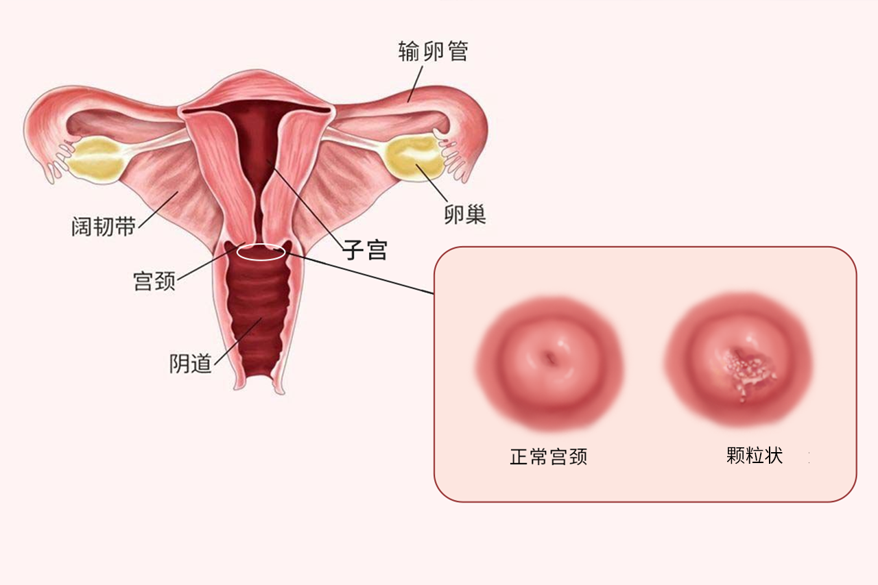 宫颈糜烂颗粒状图片（宫颈糜烂颗粒状图片大全）