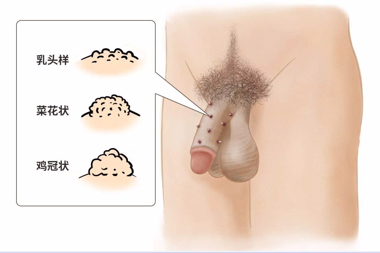 hpv6疣体长什么样（hpv6型疣体什么样子）