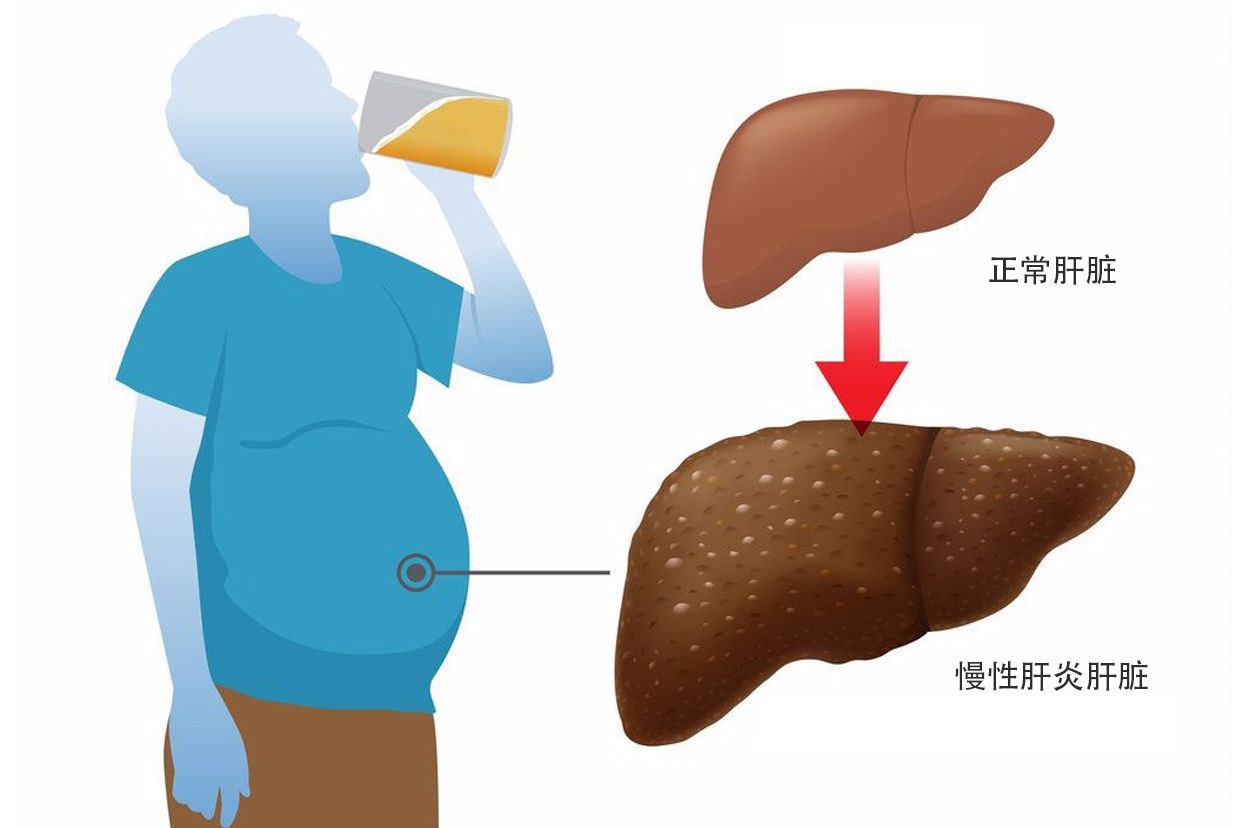 慢性肝炎图片（慢性肝炎图片高清大图）