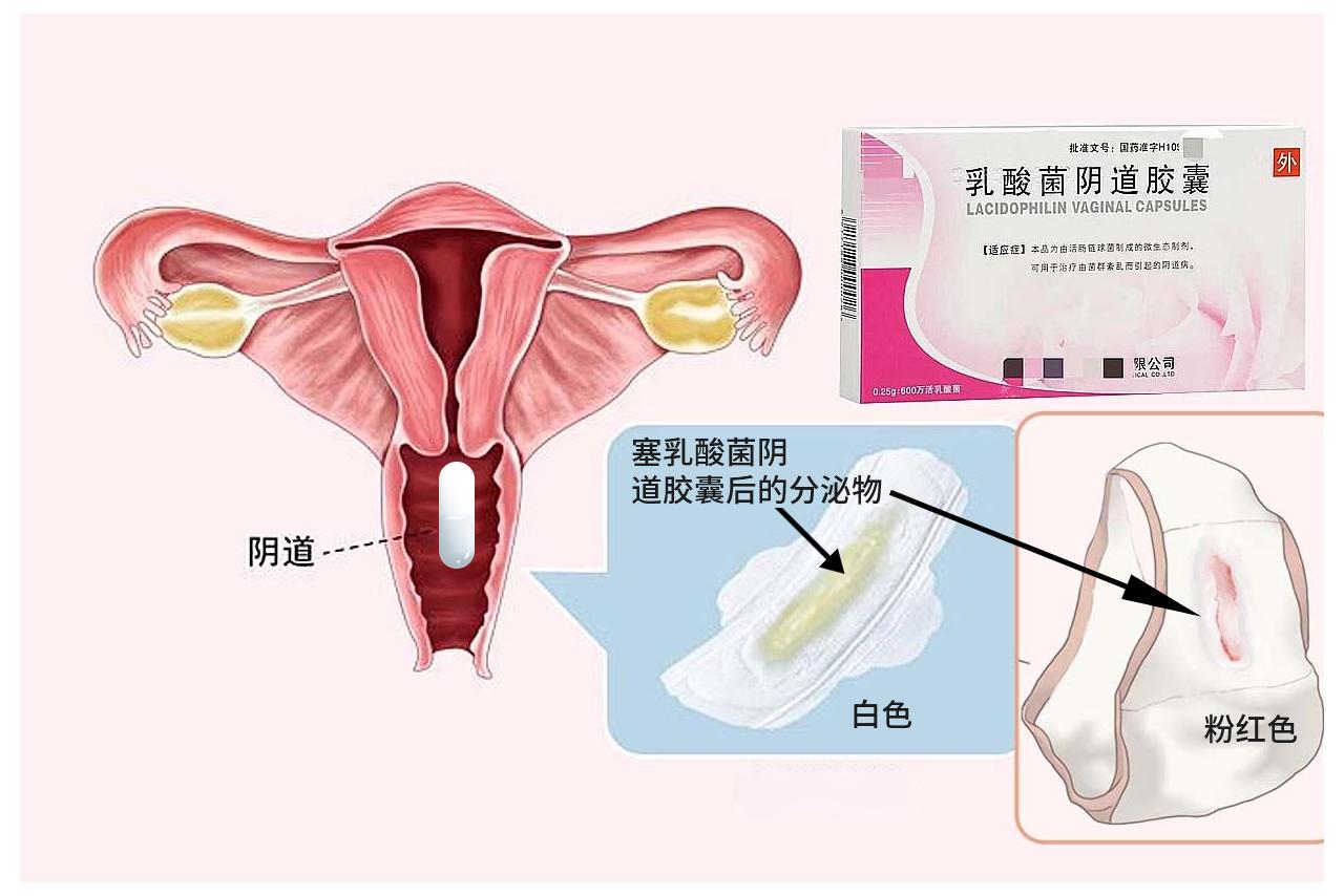 塞乳酸菌后的分泌物图片（塞了乳酸菌有什么感觉）