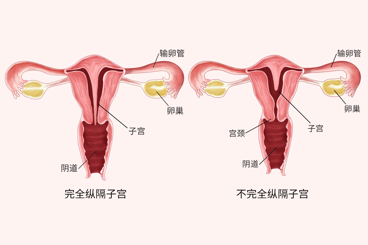 重隔子宫图片（重格子宫是什么引起的）