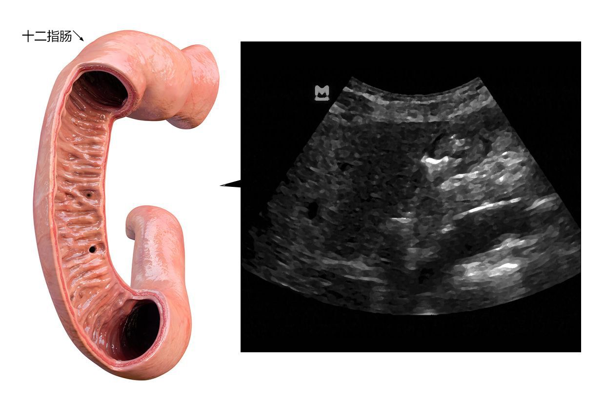十二指肠超声图像 十二指肠超声图像解剖图