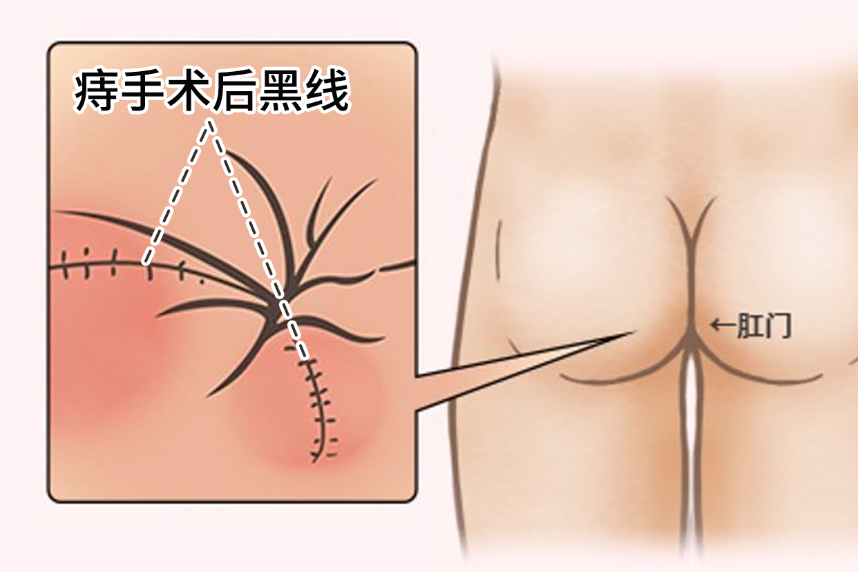 痔疮手术后黑线图片 痔疮手术后黑色的线