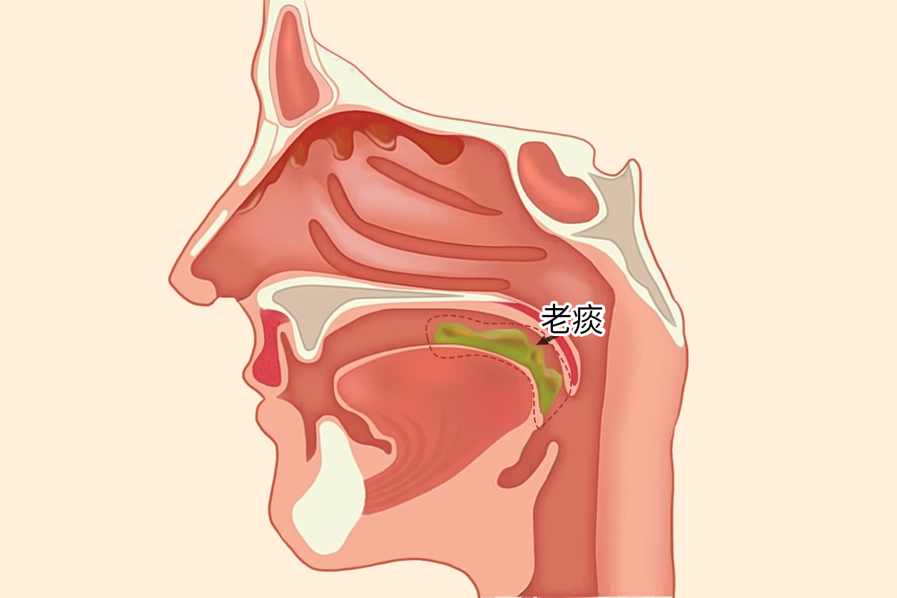 老痰图片 老痰怎么治疗