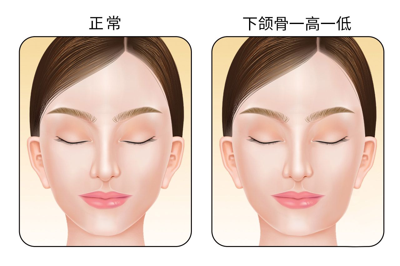 下颌骨一高一低图片 下颌骨一高一低是怎么引起的