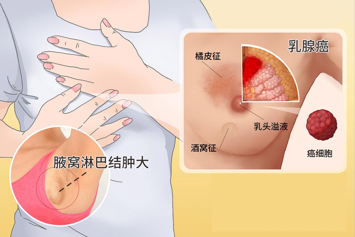 乳腺癌早期腋窝淋巴结肿大真人图片 乳腺癌早期症状腋窝淋巴有变化吗