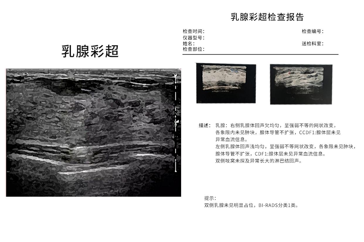 乳腺彩超报告看图片还是看结果 乳腺彩超报告看图片还是看结果呢