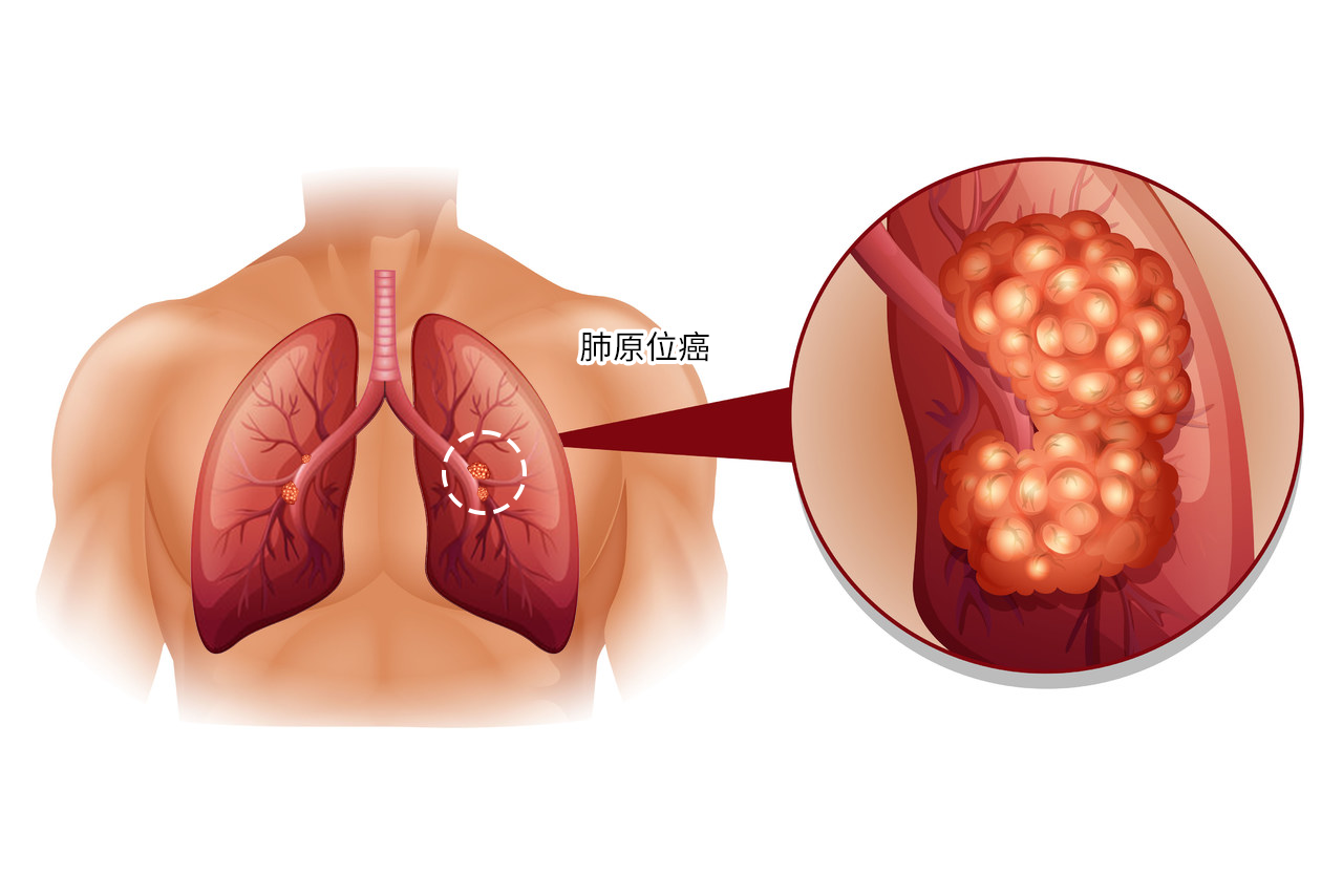 肺原位癌图 肺原位癌图片