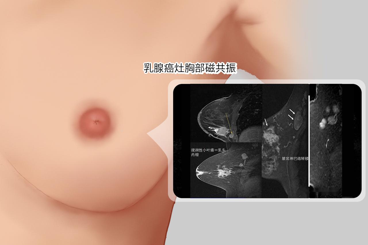 乳腺癌灶胸部磁共振图片 乳腺癌的磁共振影像表现