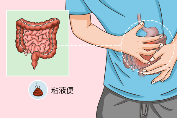 溃疡性结肠炎粘液便图片（溃疡性结肠炎拉粘液便是不是很严重）