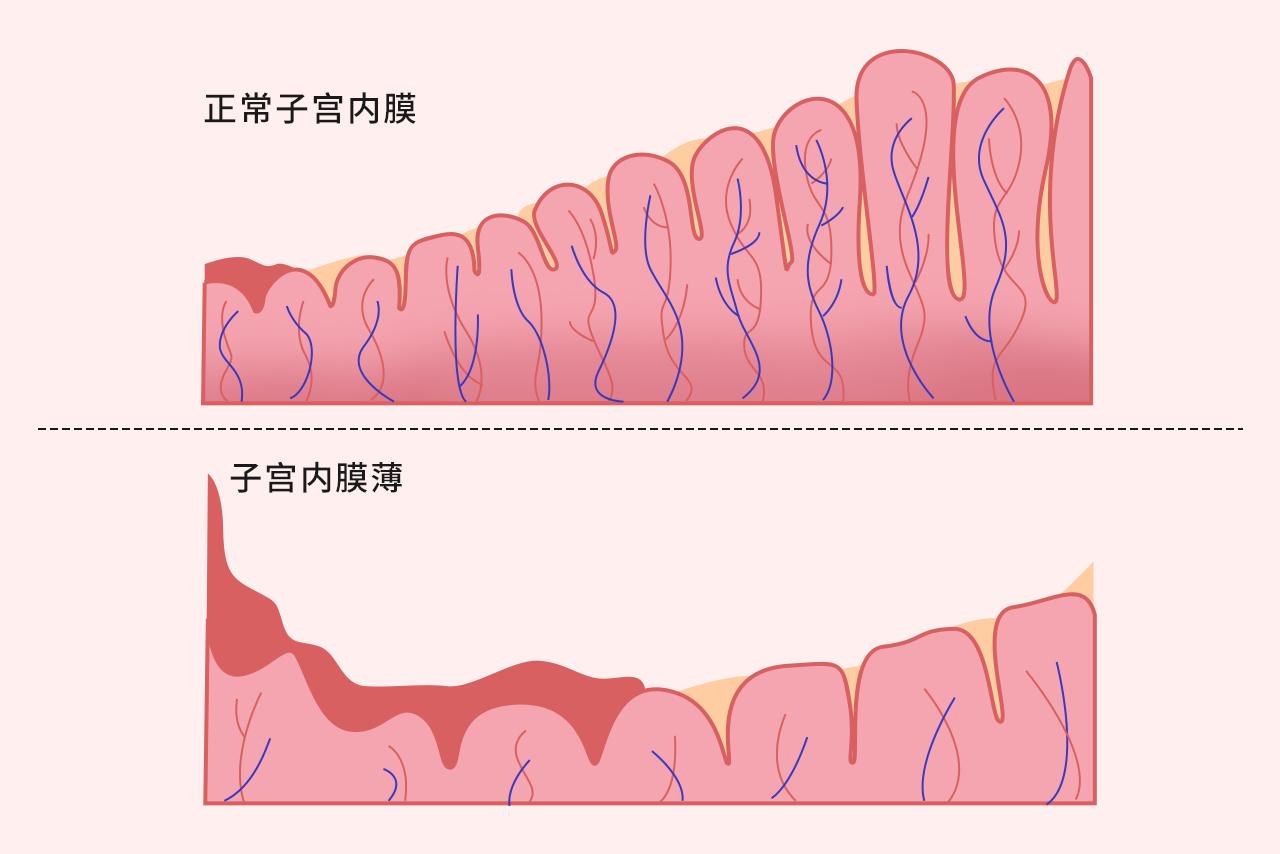 子宫内膜薄图片（子宫内膜薄的图片和正常的图片对比）