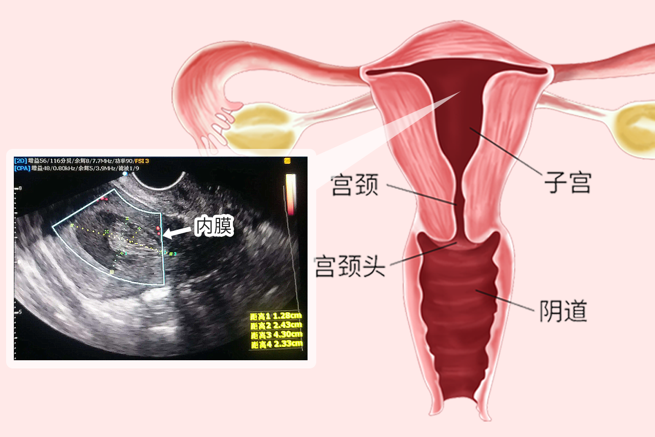 子宫内膜彩超图解（子宫内膜彩超图解图片）