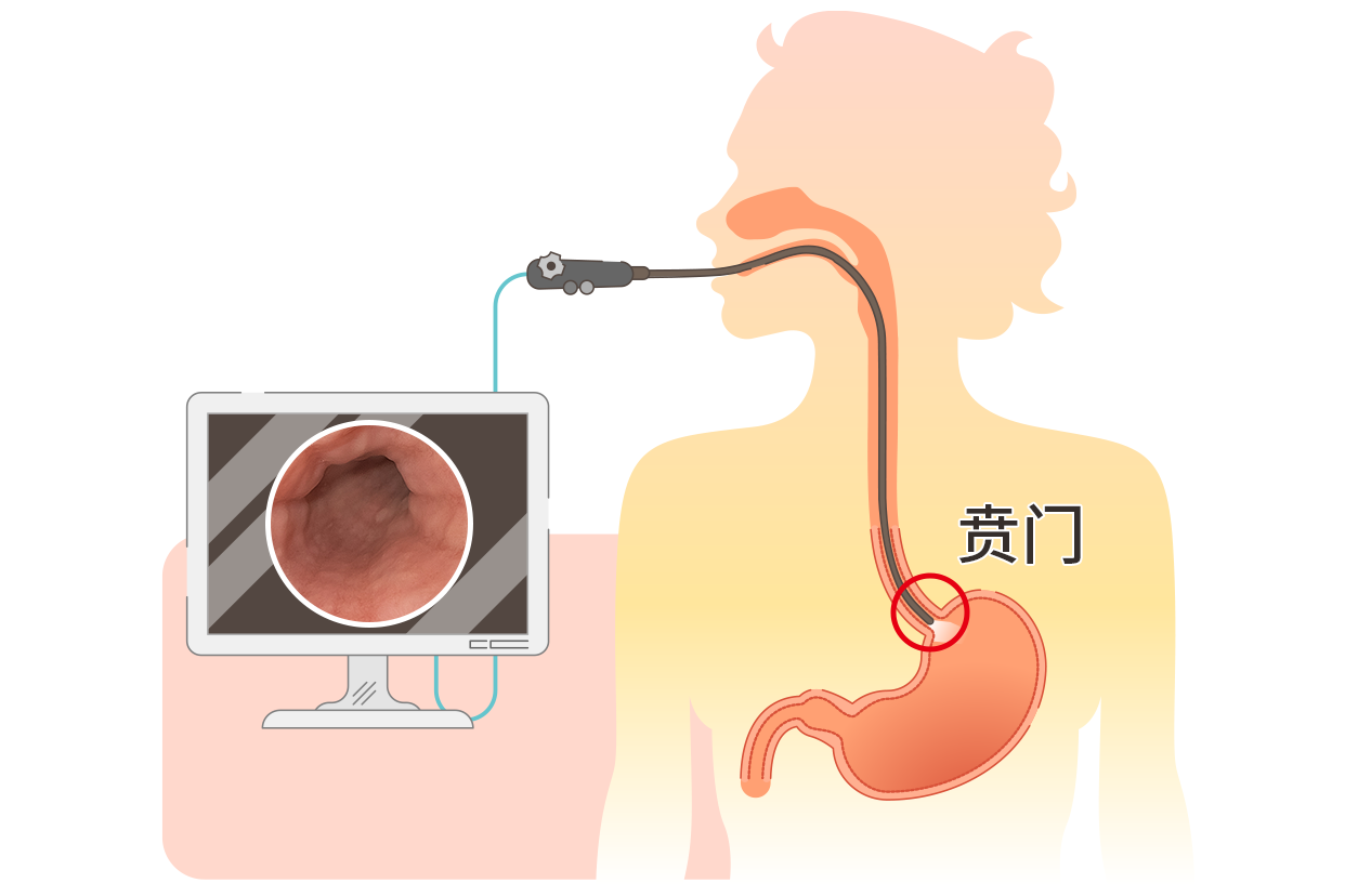 胃镜正常的贲门图片（胃镜贲门口图片）