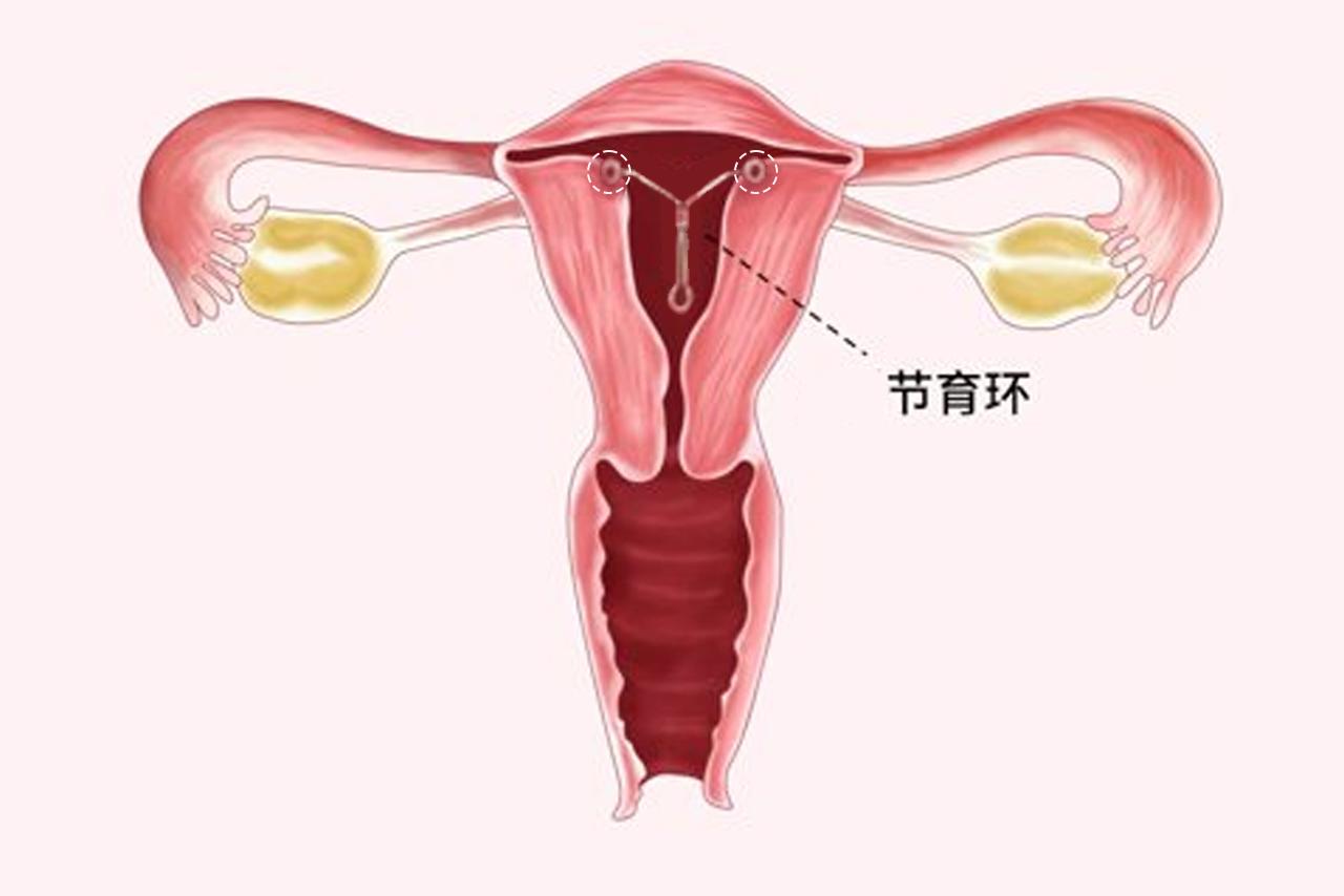 带环长肉上的图片 带环长肉里面了怎么办