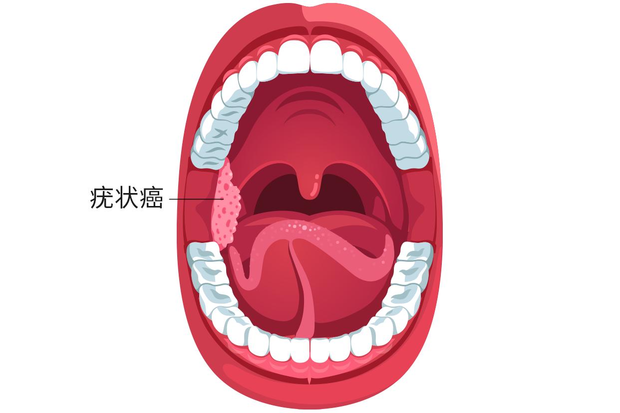 疣状癌图片 疣状癌是怎么得的病