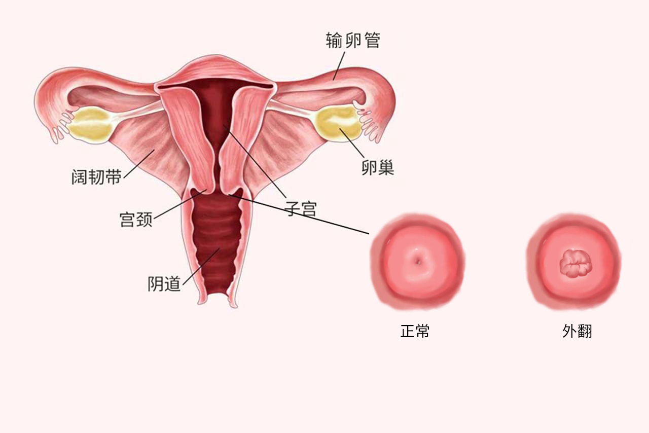 宫颈外翻图片（宫颈外翻图片实图）