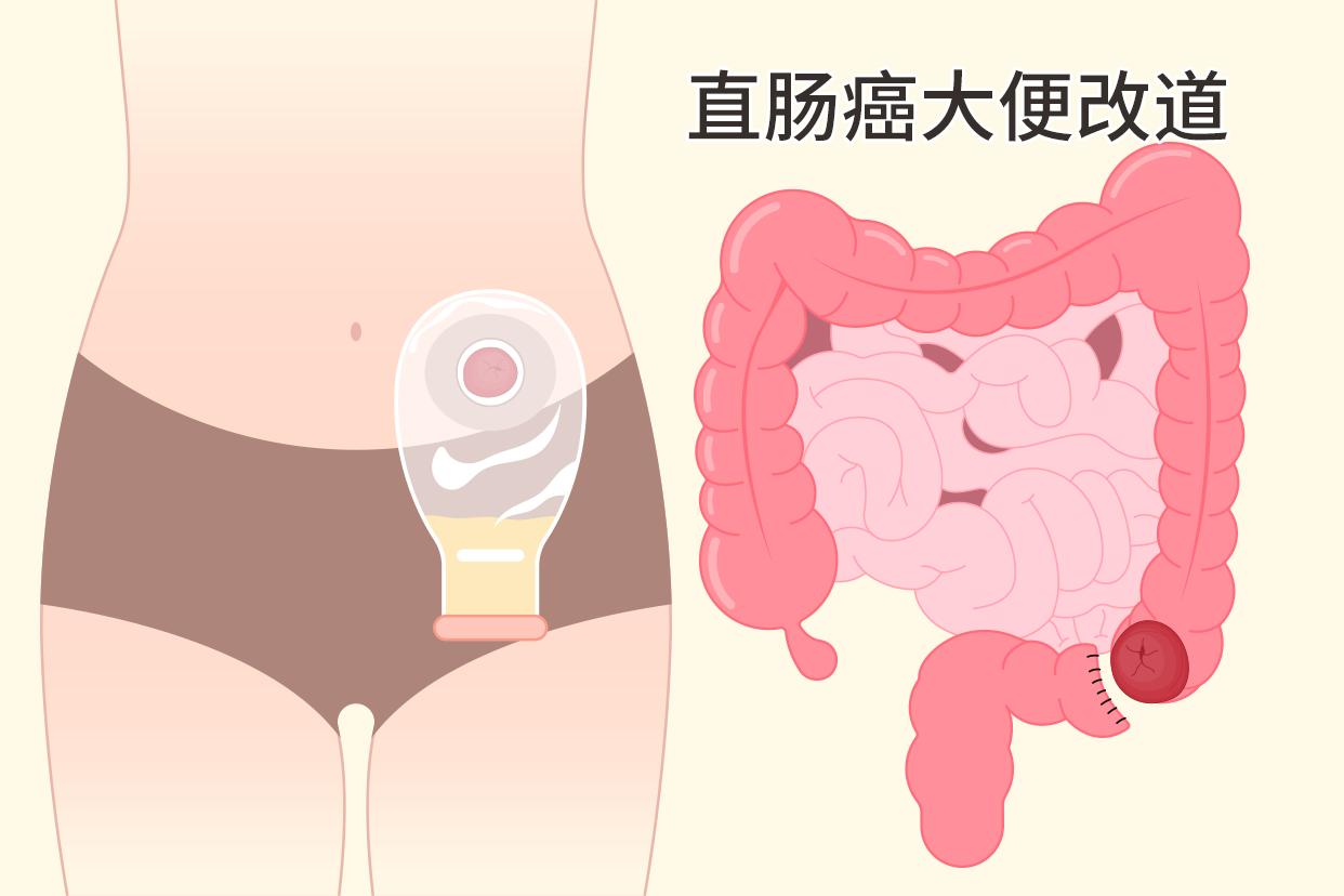 直肠癌大便改道图片 直肠癌改道大便不通怎么办