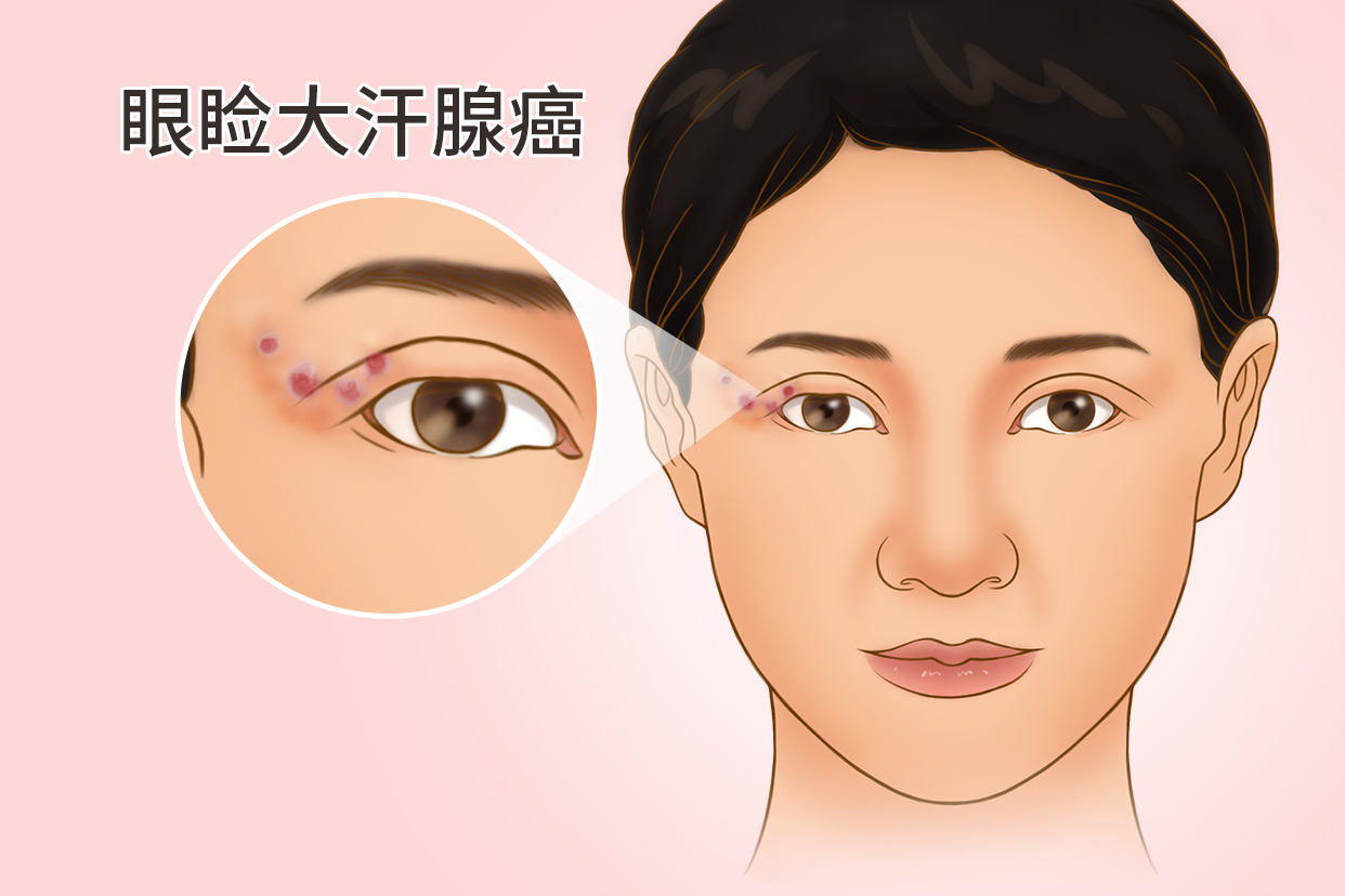 大汗腺癌皮肤图片 大汗腺癌皮肤图片