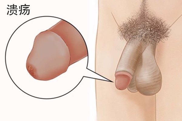 生殖溃疡图片识别 生殖溃疡图片识别