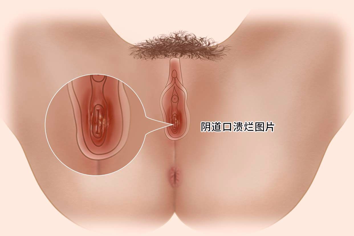 生殖溃疡图片识别 生殖溃疡图片识别