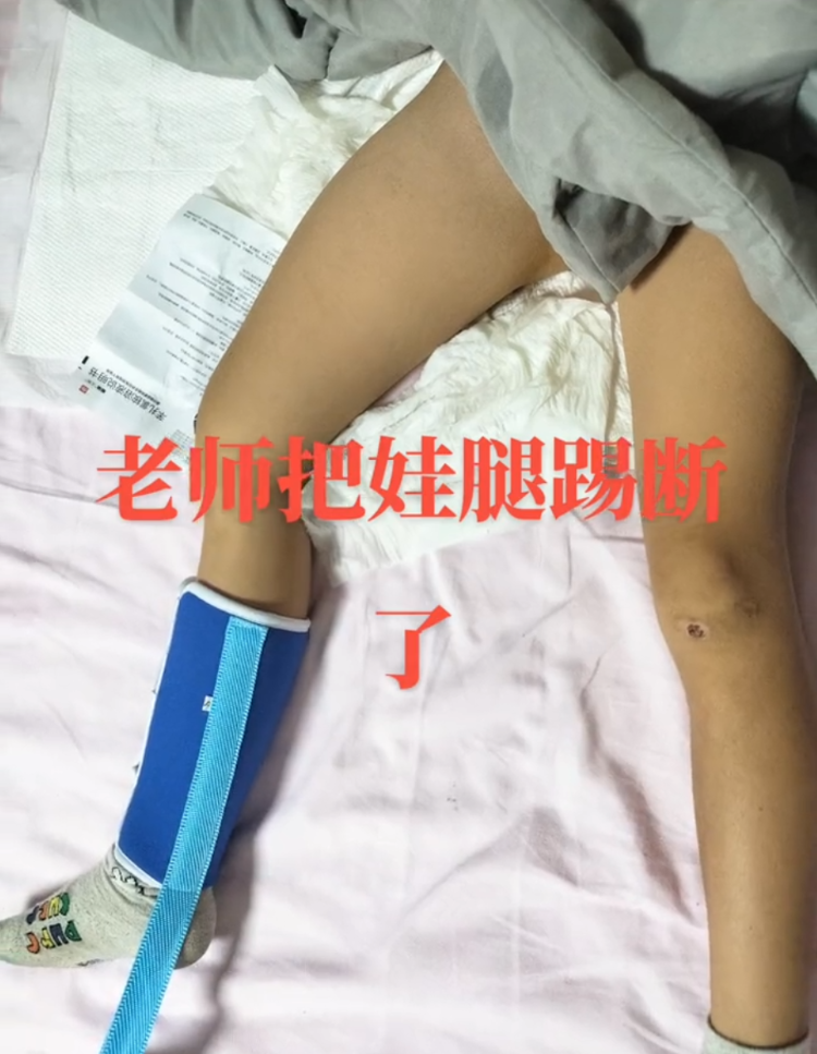 学生因没按时午休被老师踢断腿骨 学生因没按时午休被老师踢断腿骨怎么办